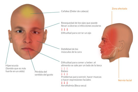 paralisis facial